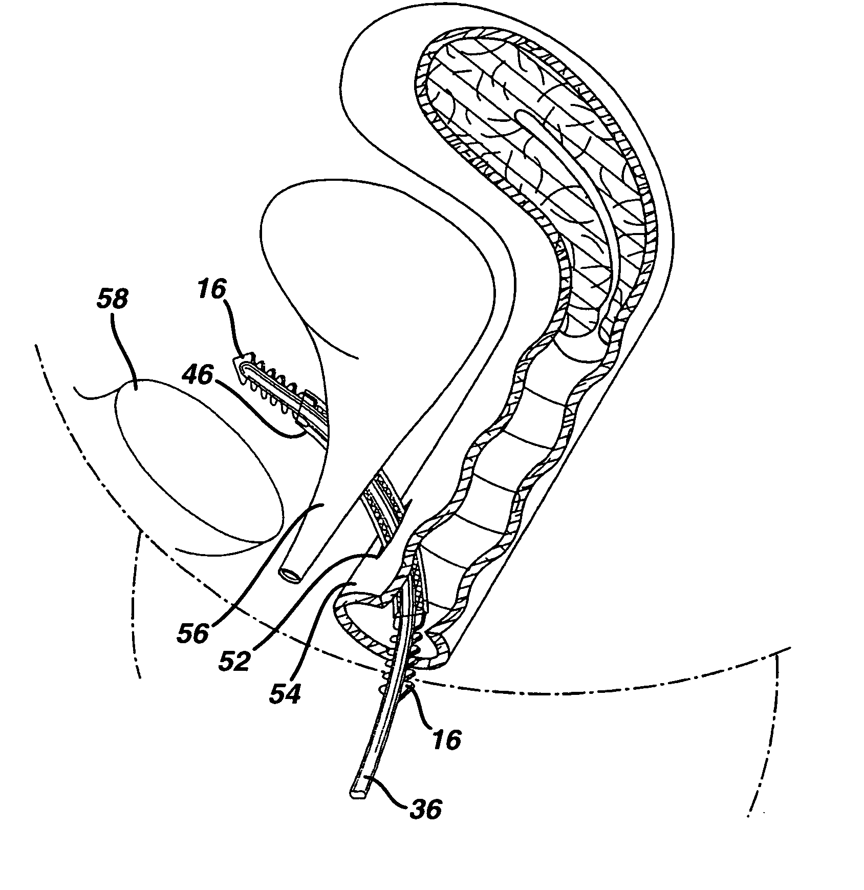 Minimally invasive medical implant and insertion device and method for using the same