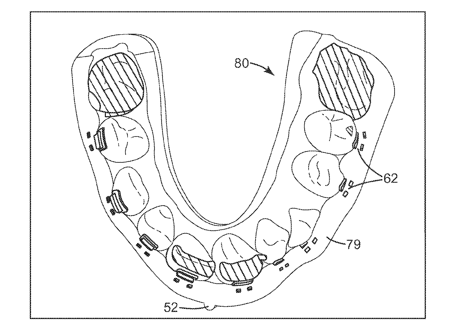 Rapid prototyped transfer tray for orthodontic appliances