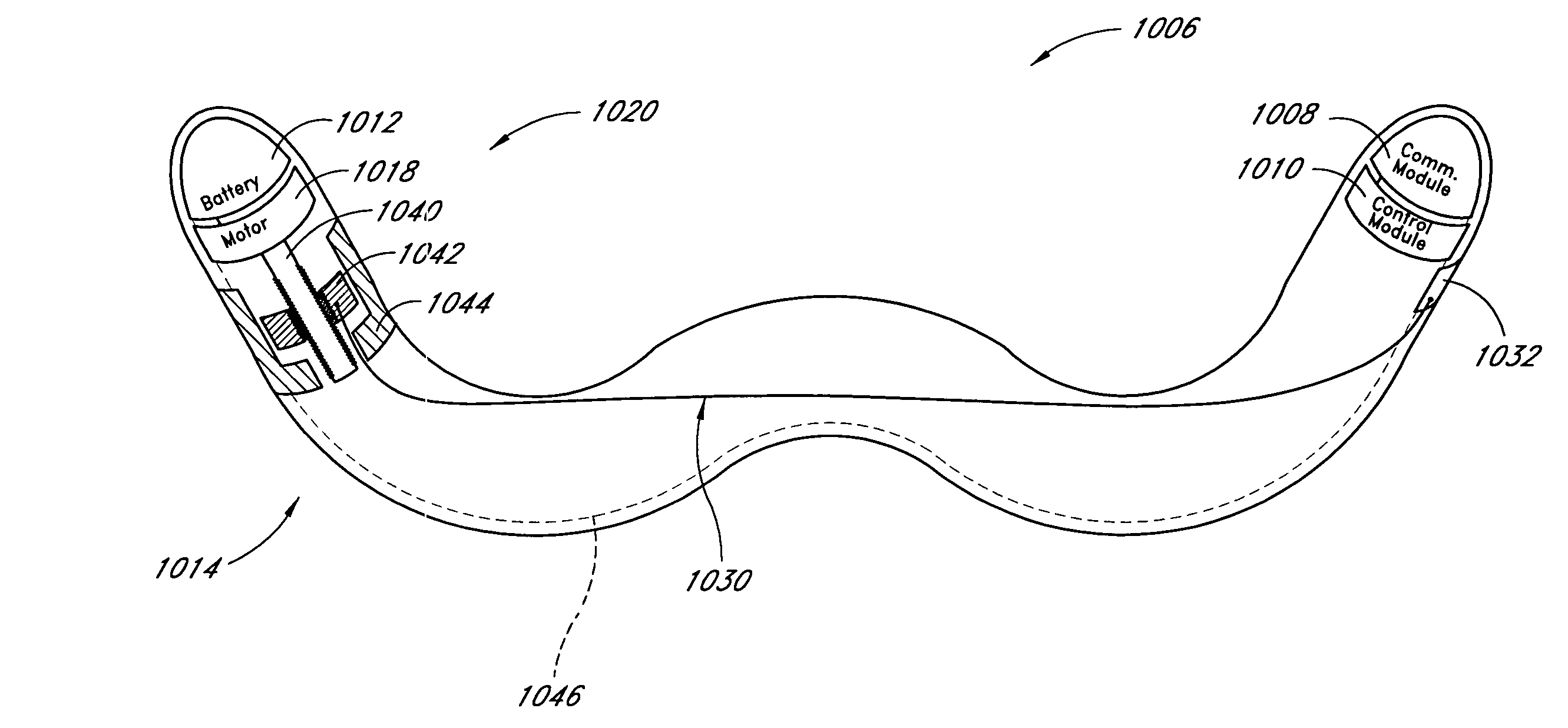 Remotely activated mitral annuloplasty system and methods