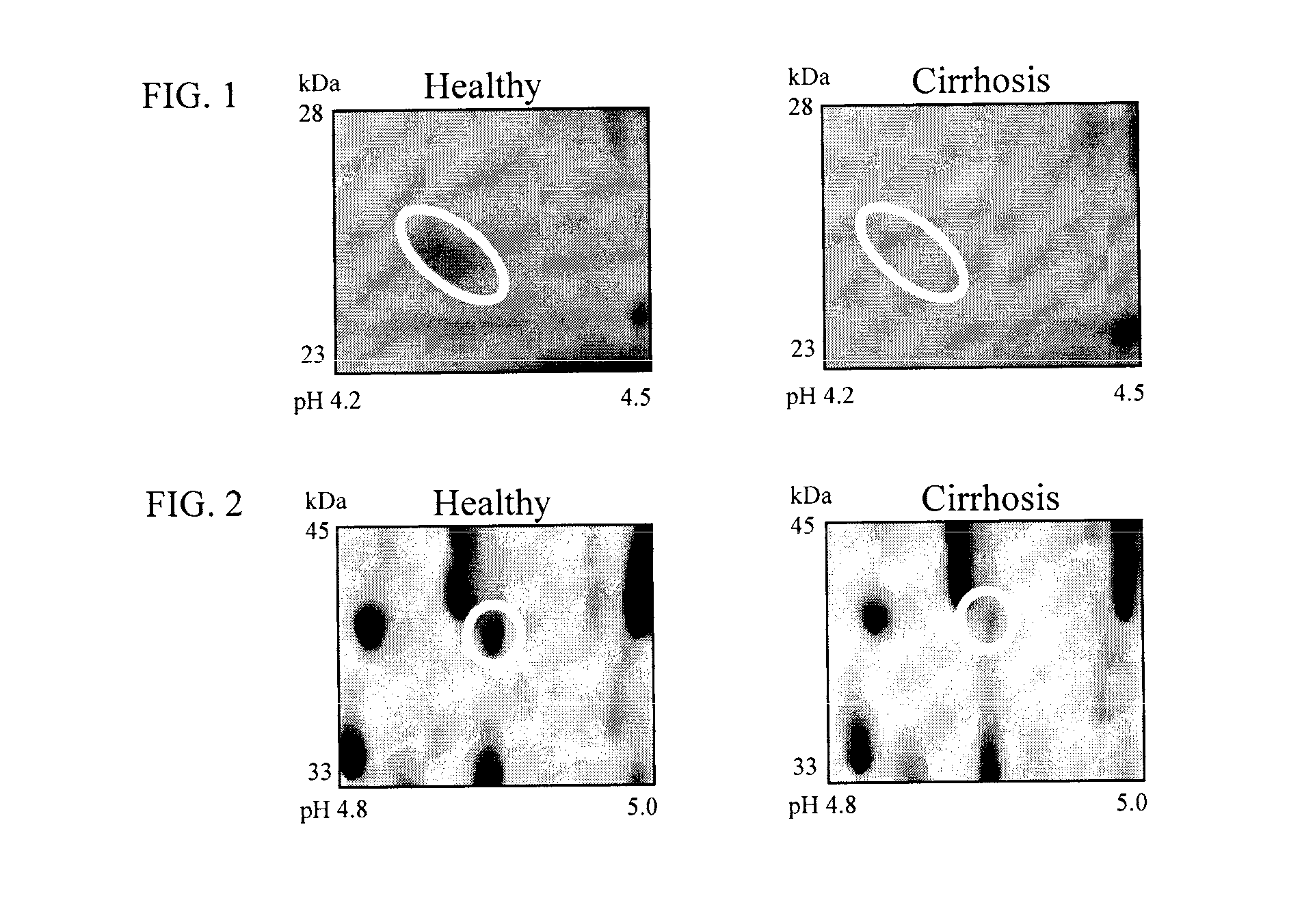 Clinical diagnosis of hepatic fibrosis using a novel panel of low abundant human plasma protein biomarkers