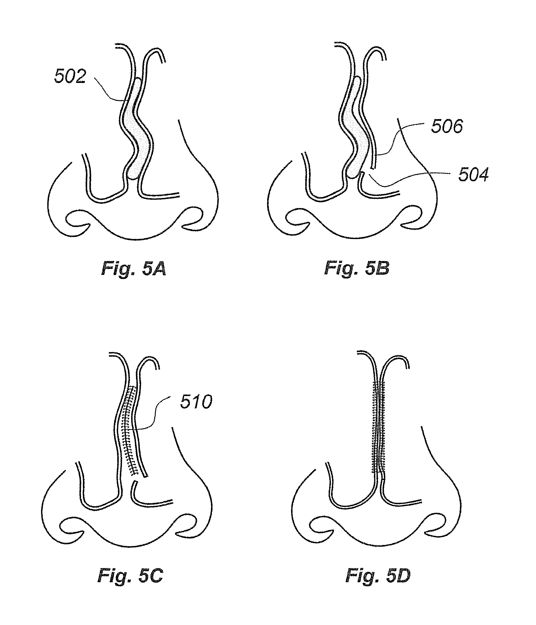 Bioresorbable septoplasty closure implant