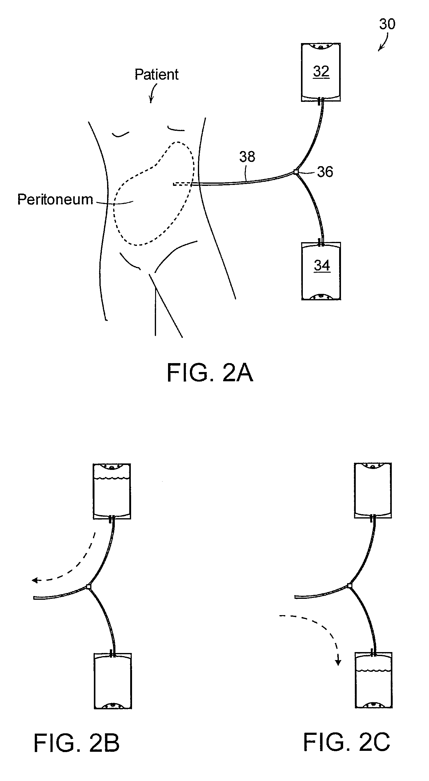 Early stage peritonitis detection apparatus and methods