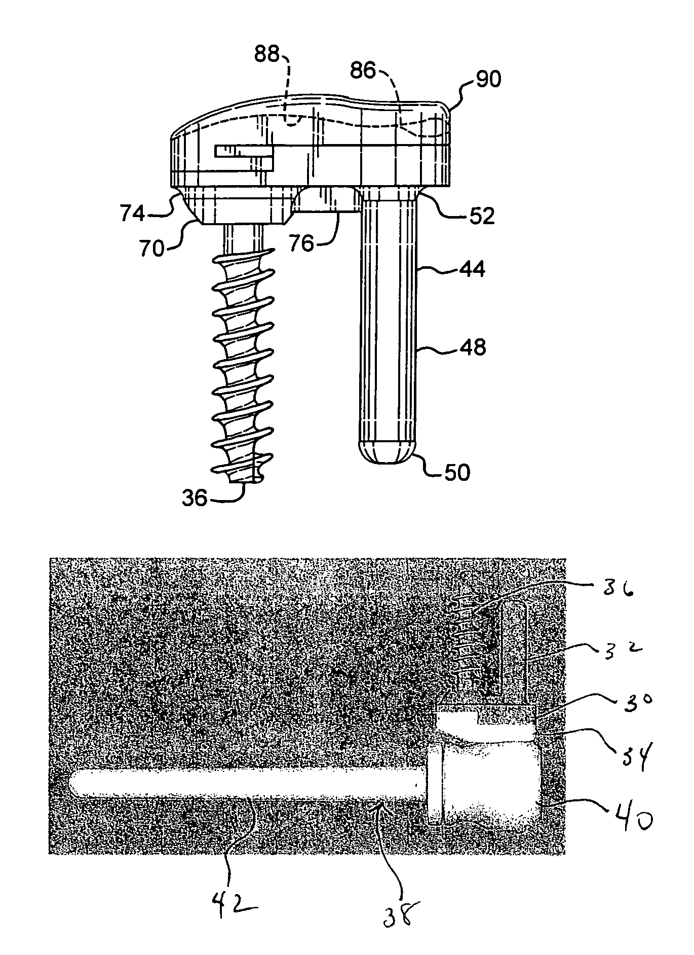 Sigmoid notch implant