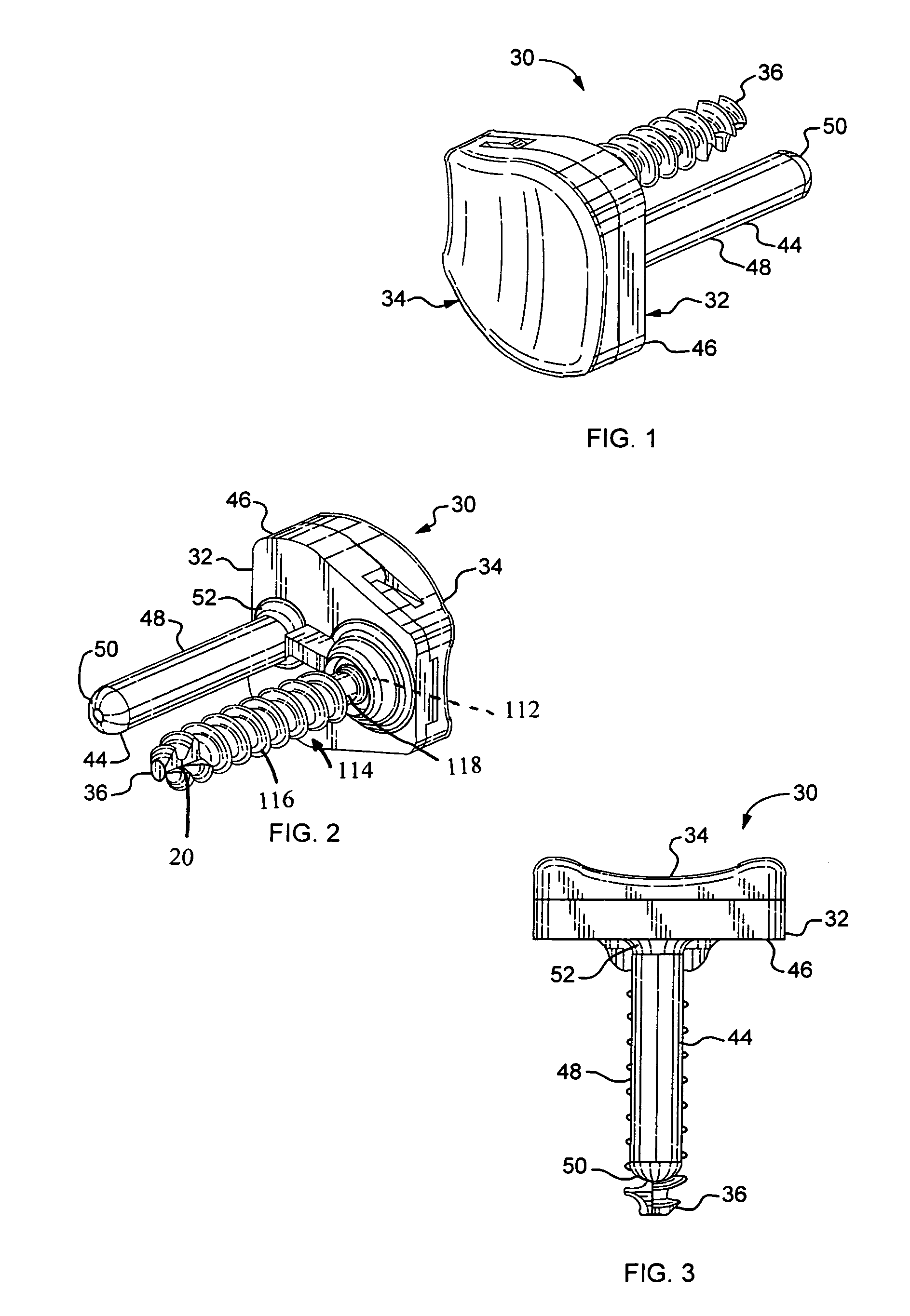 Sigmoid notch implant