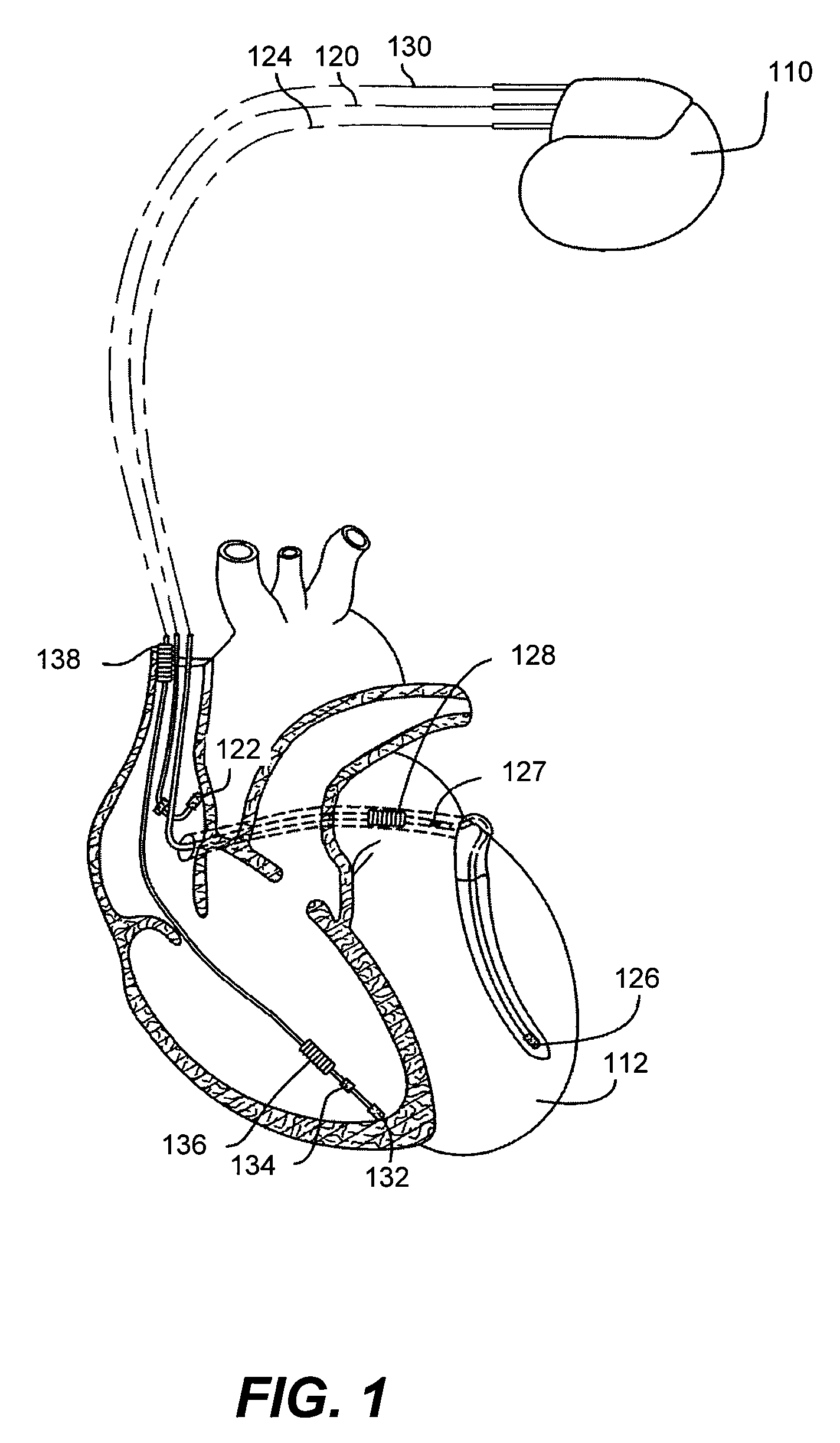 Systems and methods to synchronize commands sent to a multi-electrode lead (MEL) with a portion of a cardiac pacing cycle