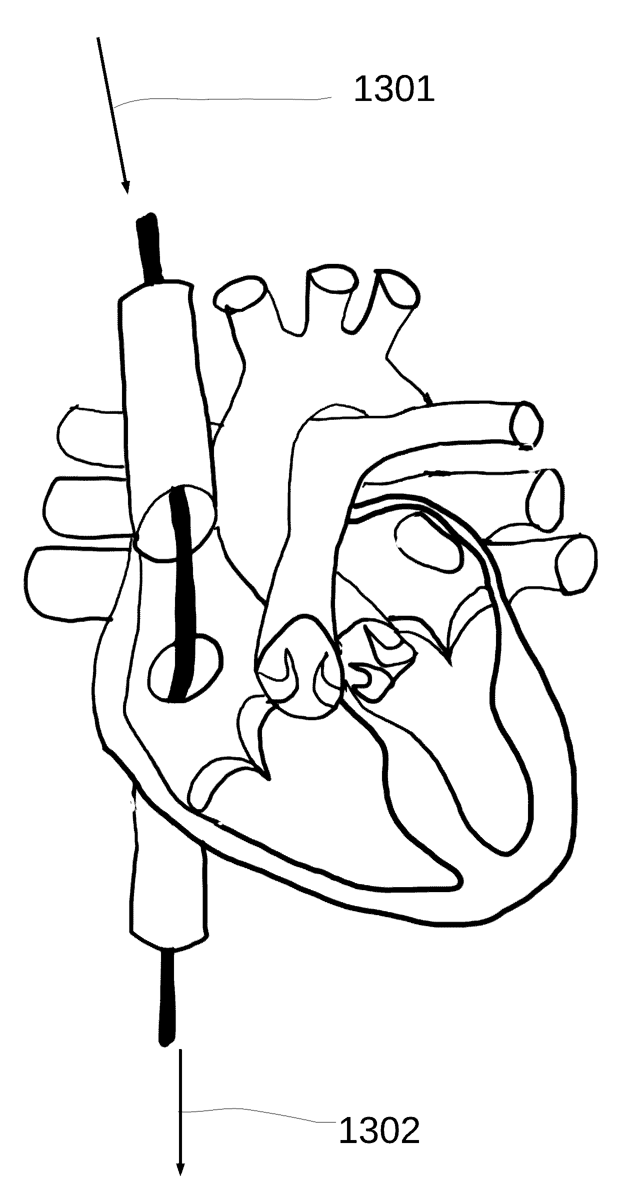 System and method for treating hepatic area vein occlusion