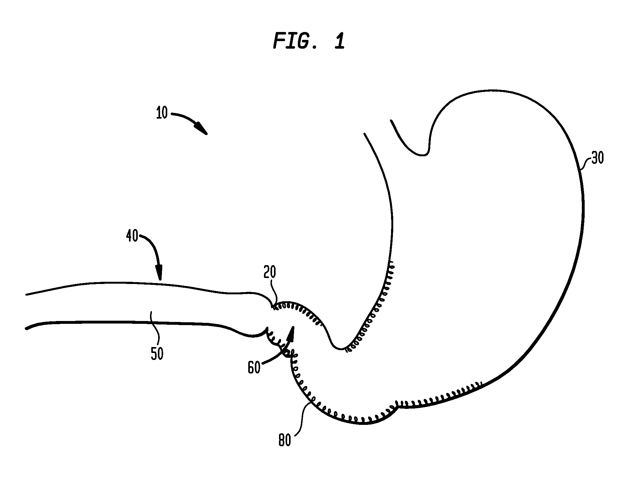 Systems and methods for treatment of obesity and type 2 diabetes