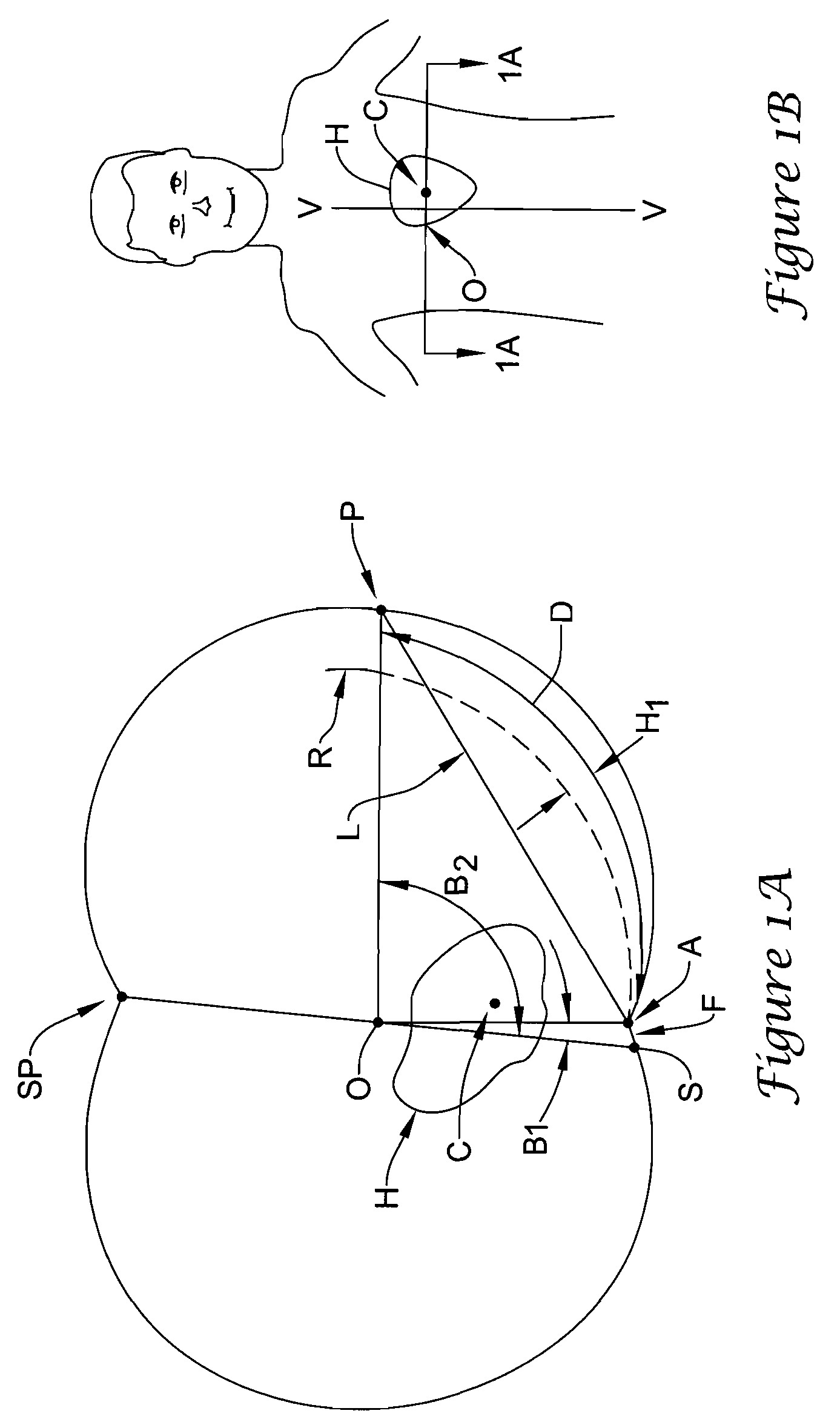 Subcutaneous implantable cardioverter-defibrillator placement methods