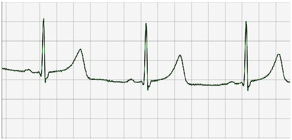 A ECG data analysis method suitable for mobile platforms