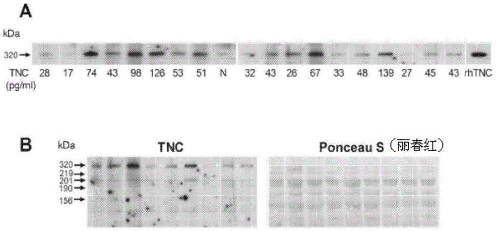 Tenascin c and its use in rheumatoid arthritis