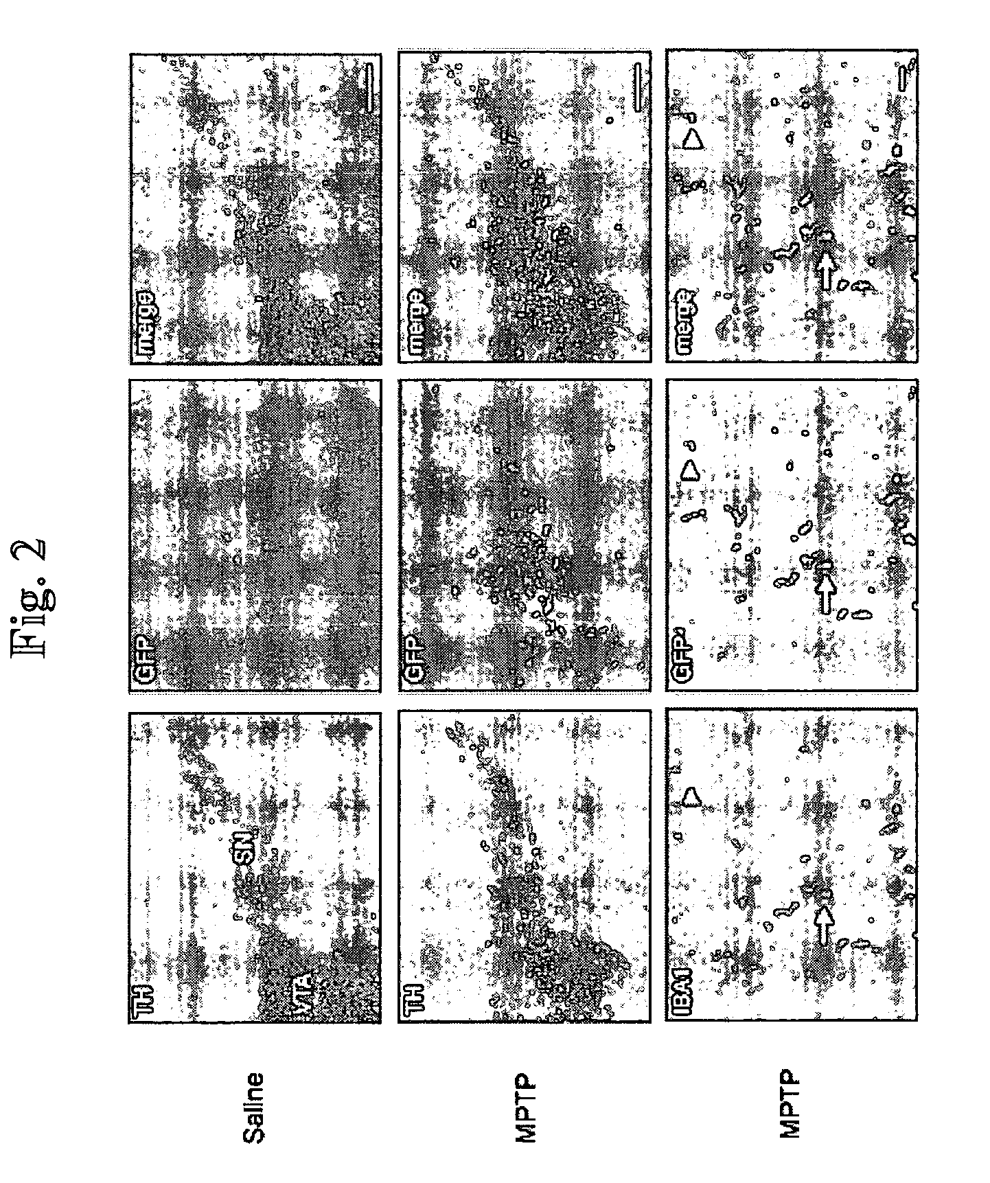 Methods and compositions for bone marrow stem cell-derived macrophage delivery of genes for gene therapy