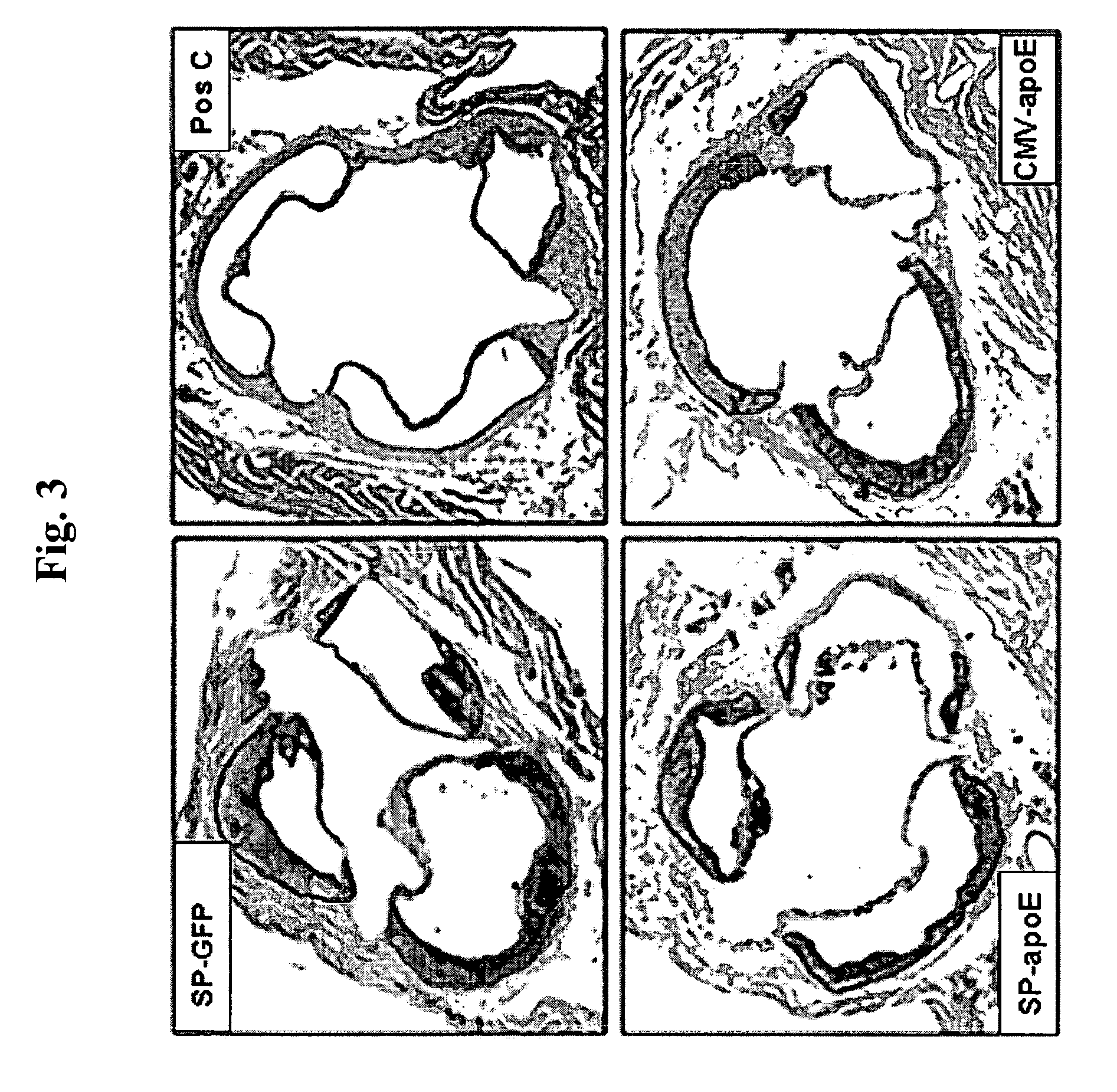 Methods and compositions for bone marrow stem cell-derived macrophage delivery of genes for gene therapy