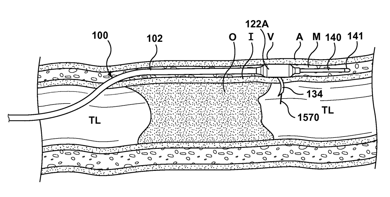 Occlusion Bypassing Apparatus With a Re-Entry Needle and a Stabilization Tube