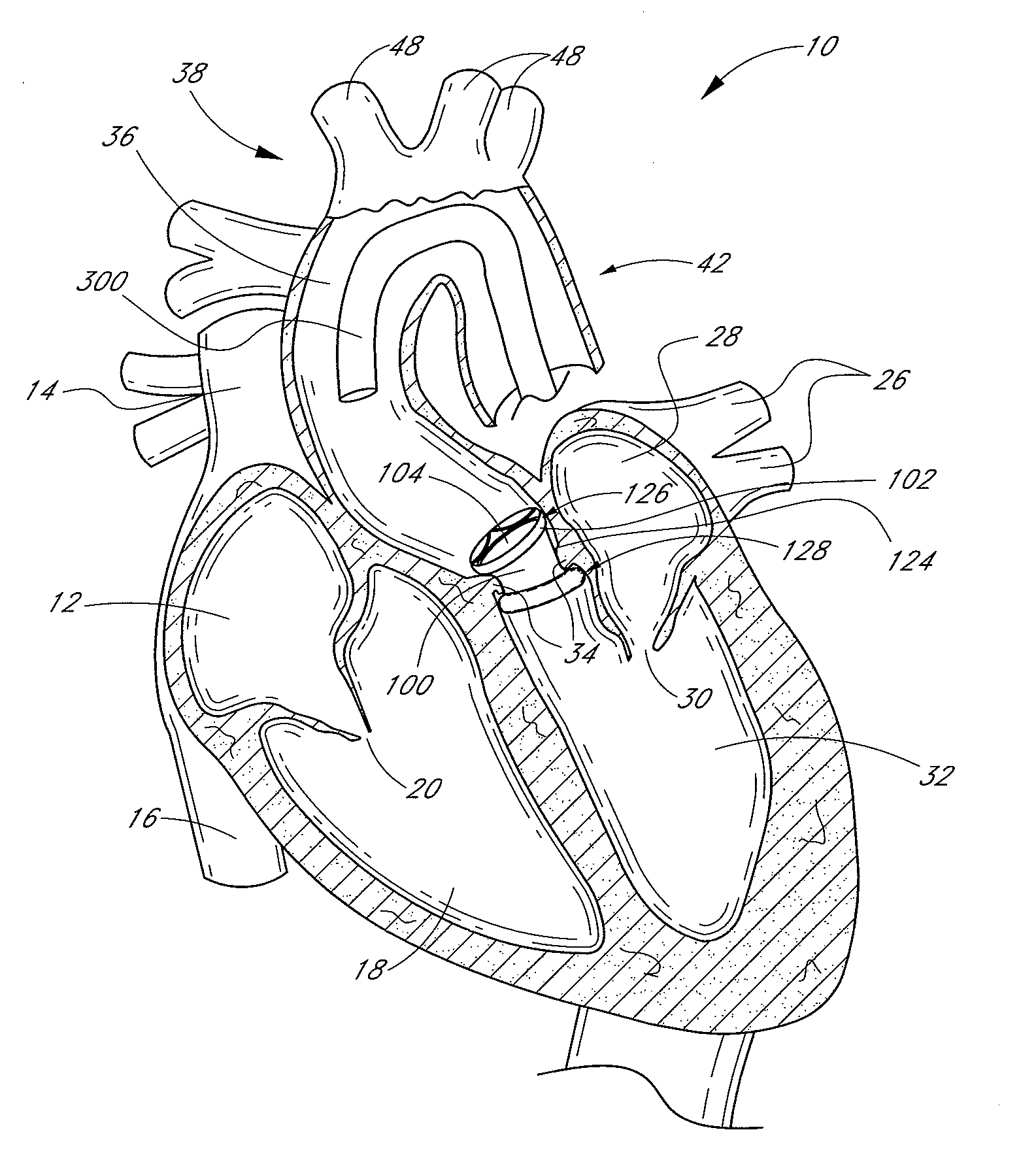 Method of in situ formation of translumenally deployable heart valve support