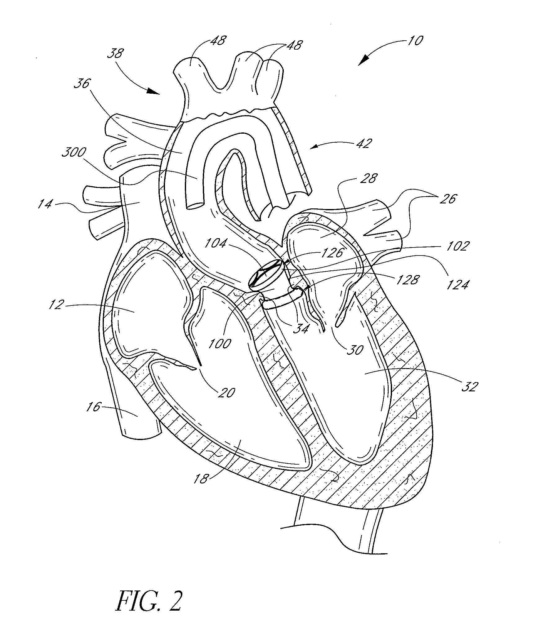 Method of in situ formation of translumenally deployable heart valve support