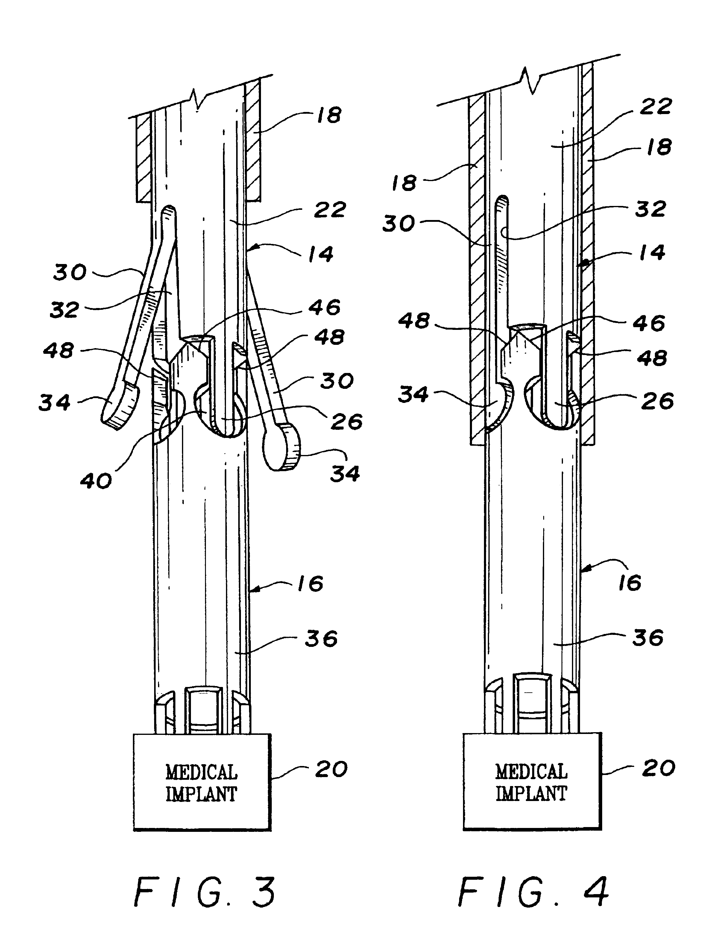 Over-the-wire interlock attachment/detachment mechanism