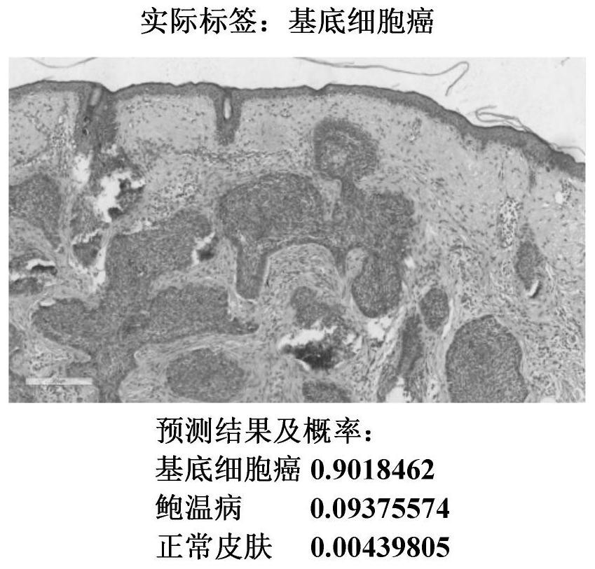 Skin basal cell carcinoma and abalone warm disease recognition method based on deep learning