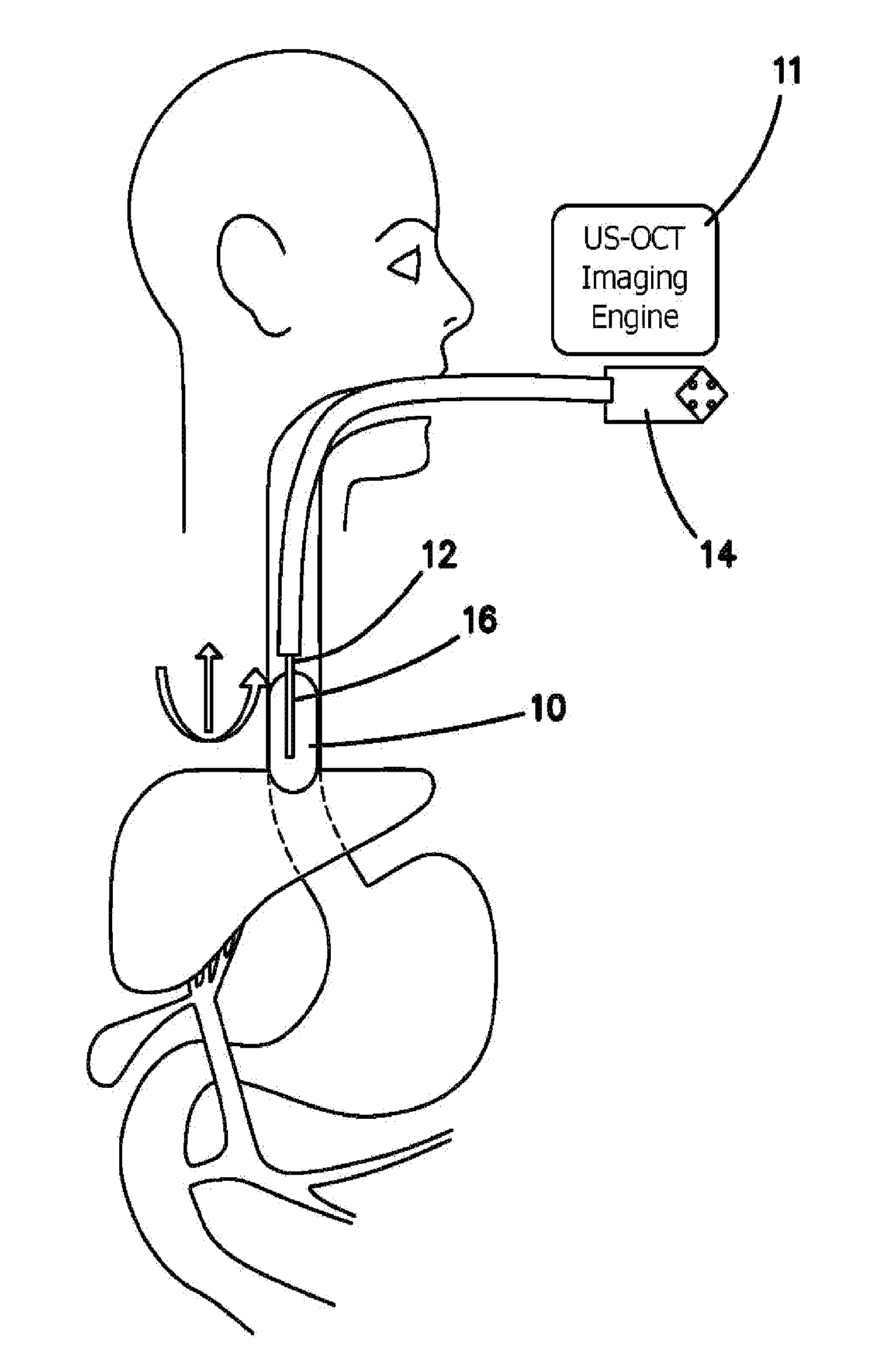 Integrated Ultrasound, OCT, PA and/or Florescence Imaging Endoscope for Diagnosing Cancers in Gastrointestinal, Respiratory, and Urogenital Tracts