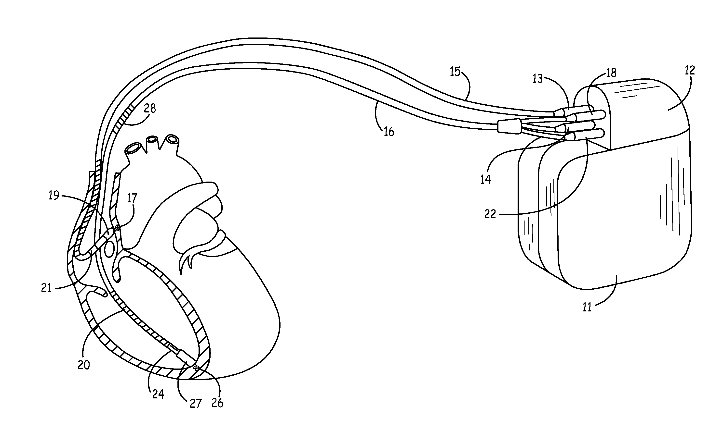 Method and apparatus for detecting and treating tachyarrhythmias incorporating diagnostic/therapeutic pacing techniques