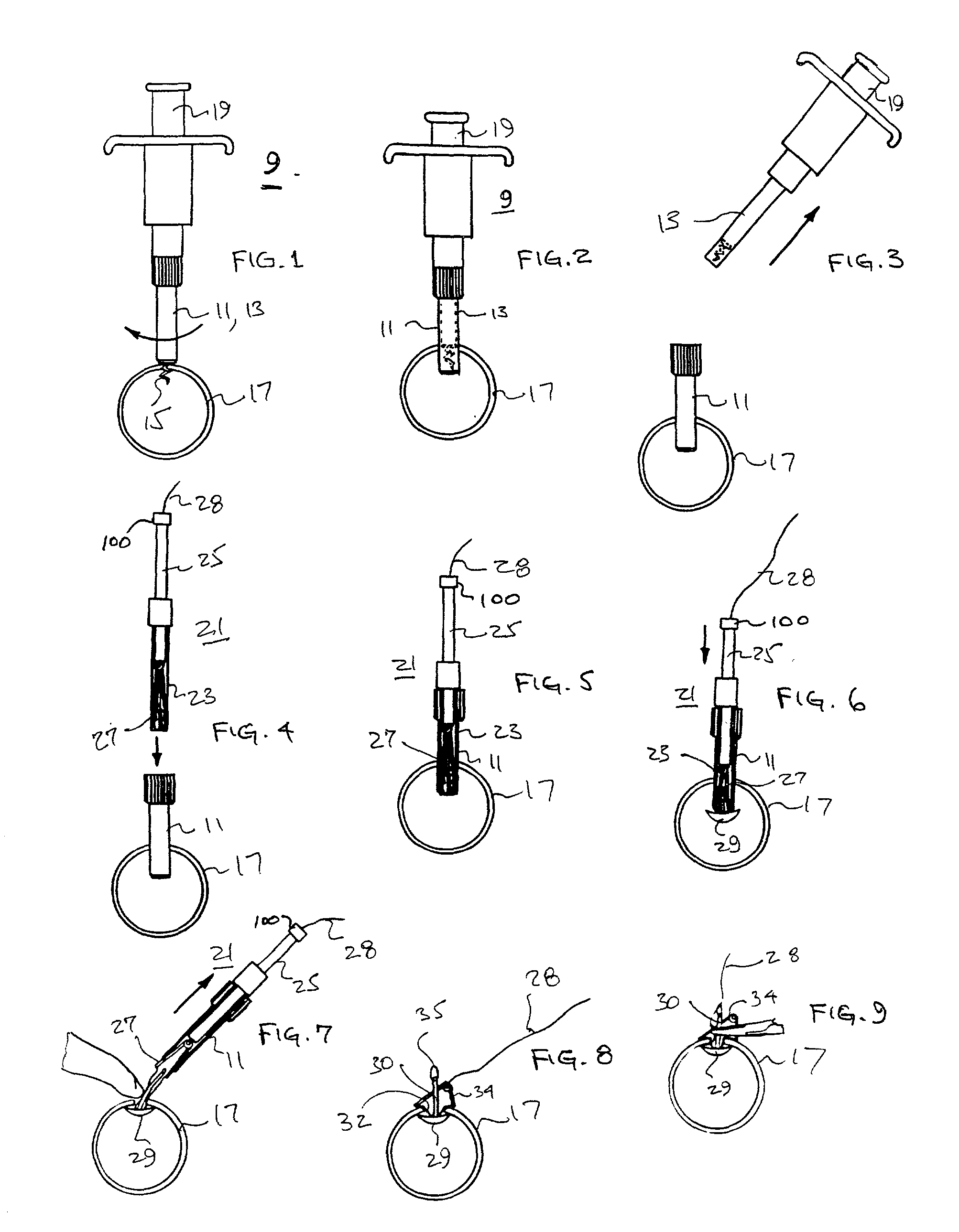 Temporary anastomotic seal and method