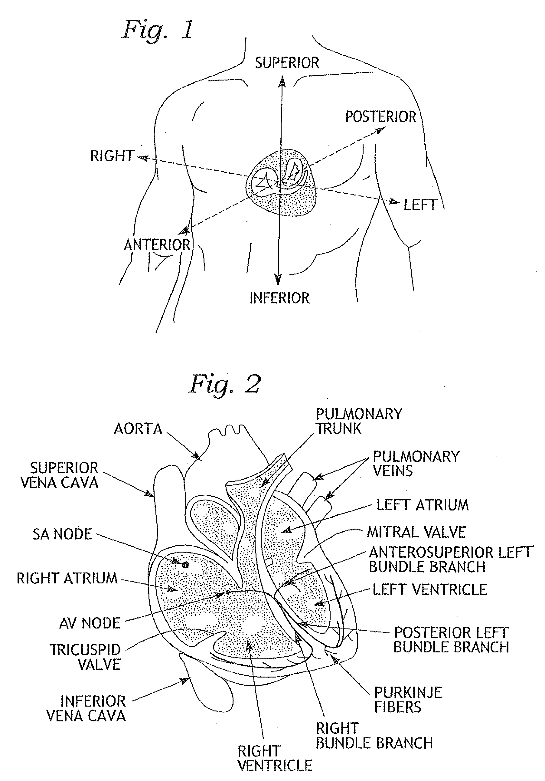 Physiologically harmonized tricuspid annuloplasty ring