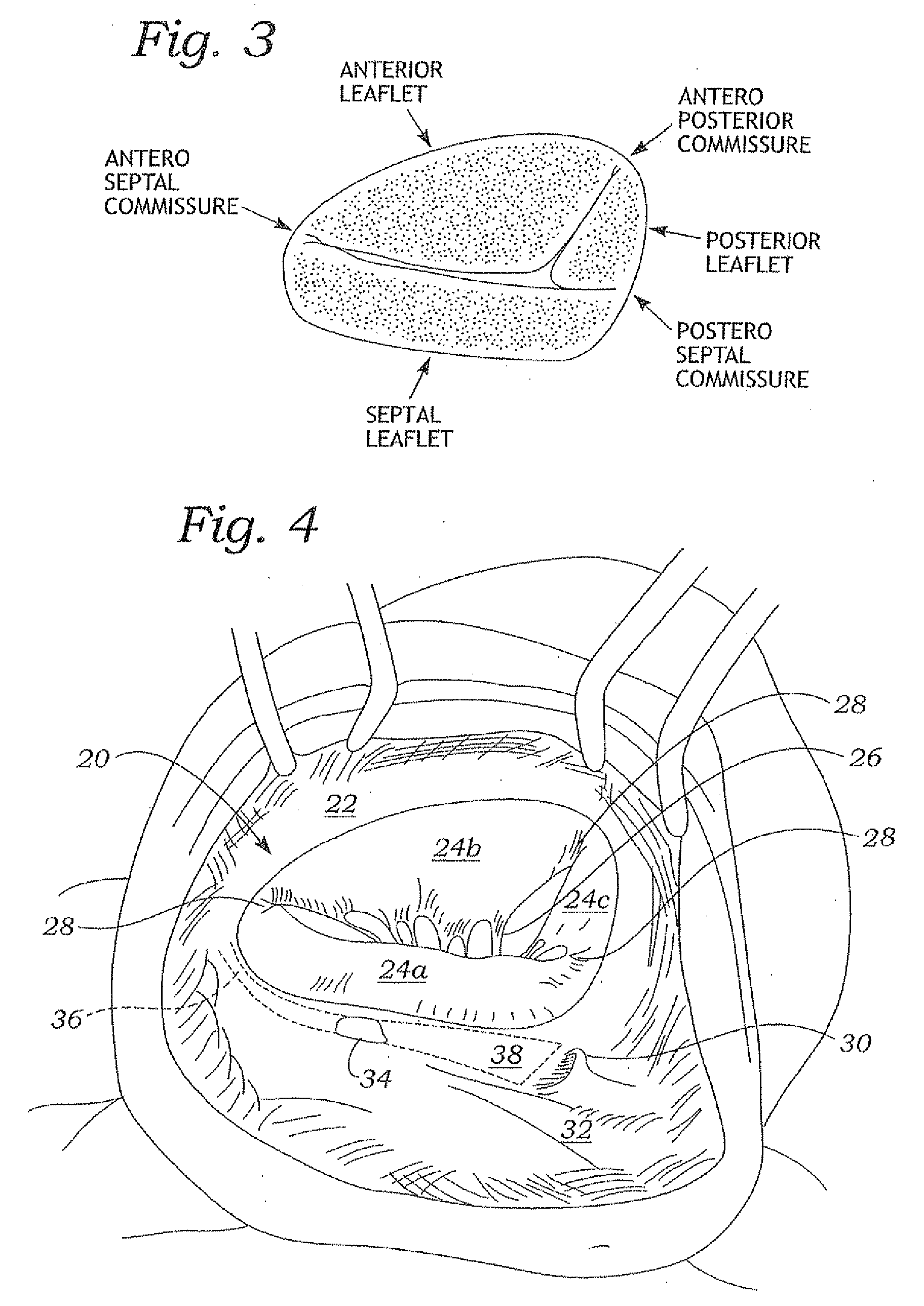 Physiologically harmonized tricuspid annuloplasty ring