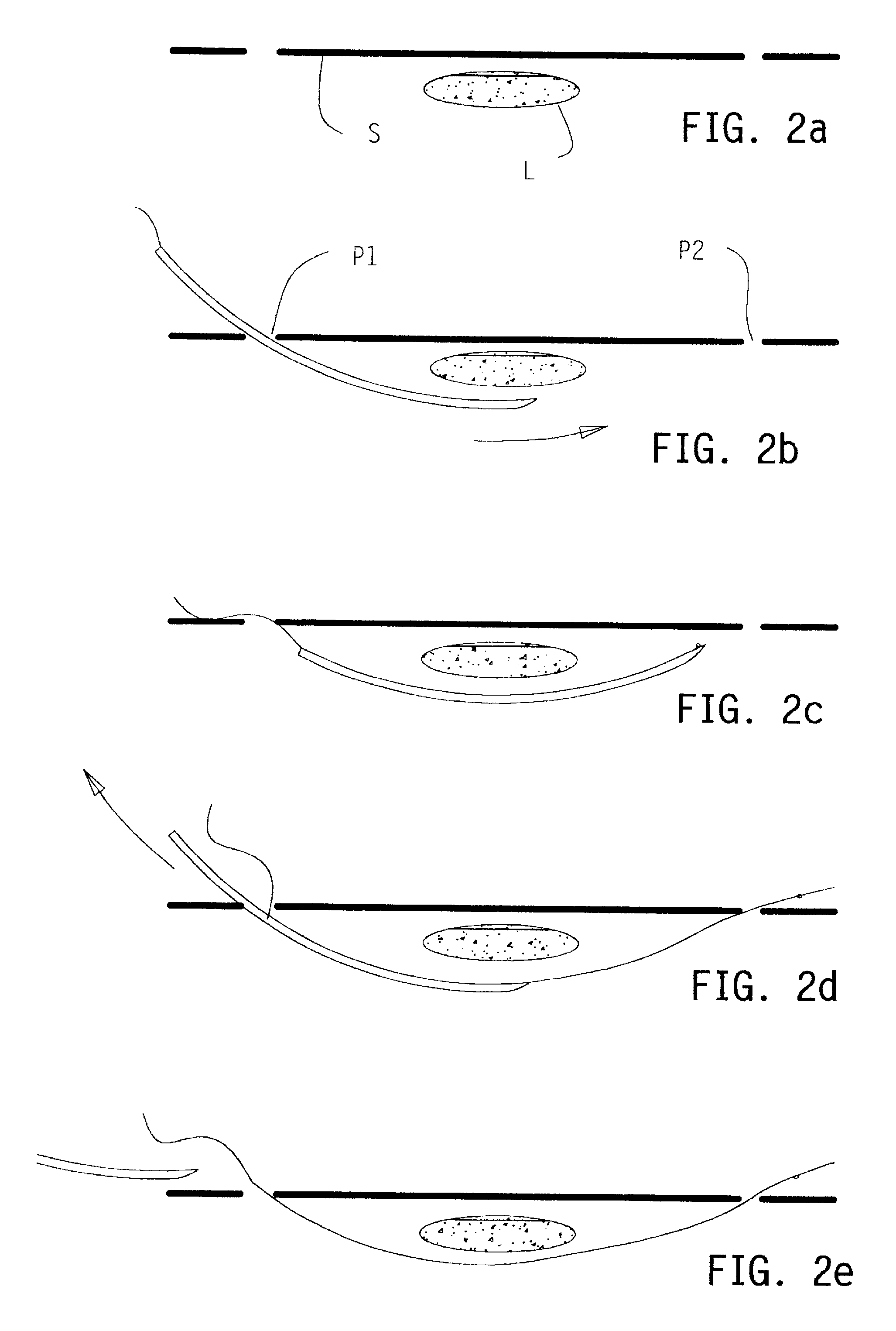 Flexible Wire Transection of the Transverse Carpal Ligament