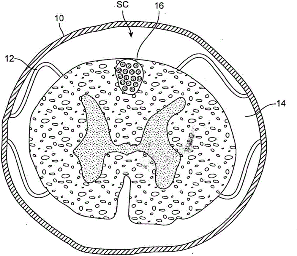 Remotely controlled and/or laterally supported devices for direct spinal cord stimulation