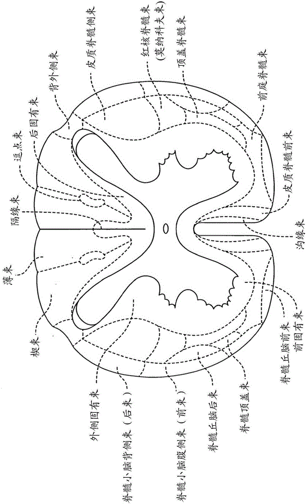 Remotely controlled and/or laterally supported devices for direct spinal cord stimulation