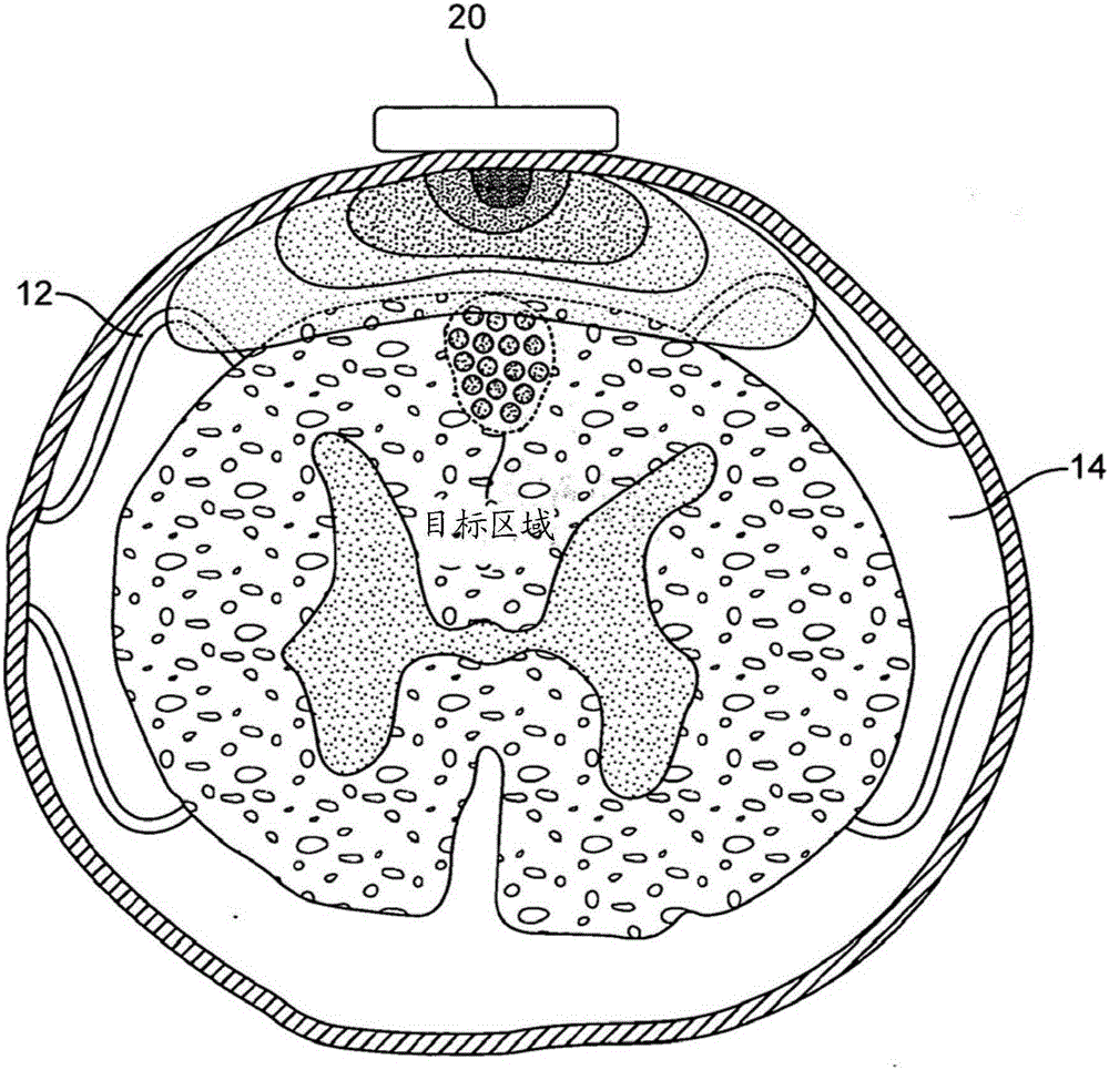 Remotely controlled and/or laterally supported devices for direct spinal cord stimulation