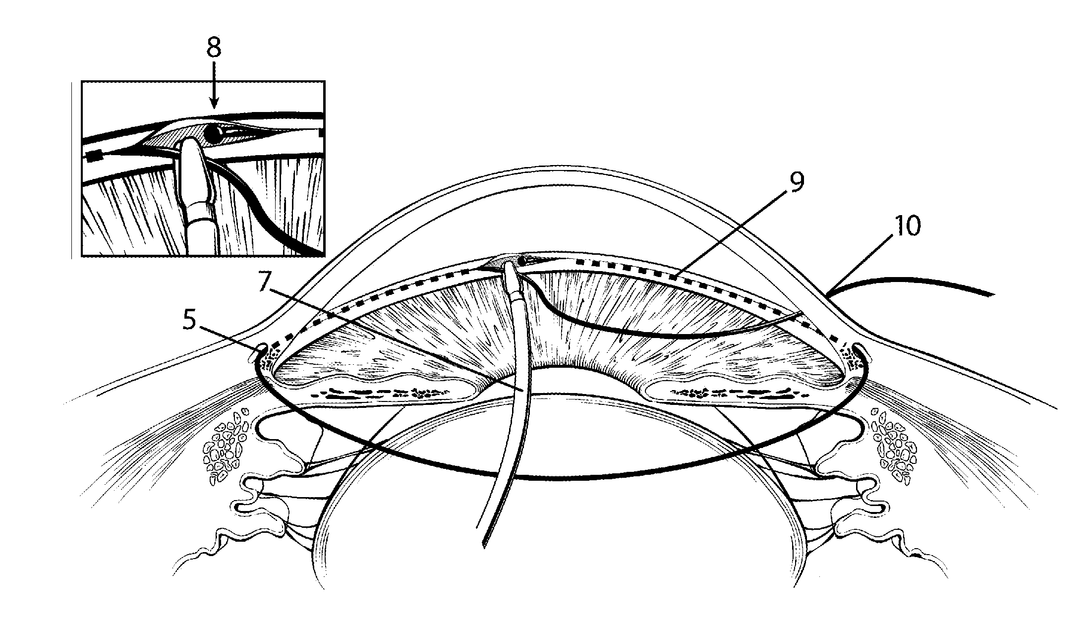 Method and apparatus for treating an ocular disorder