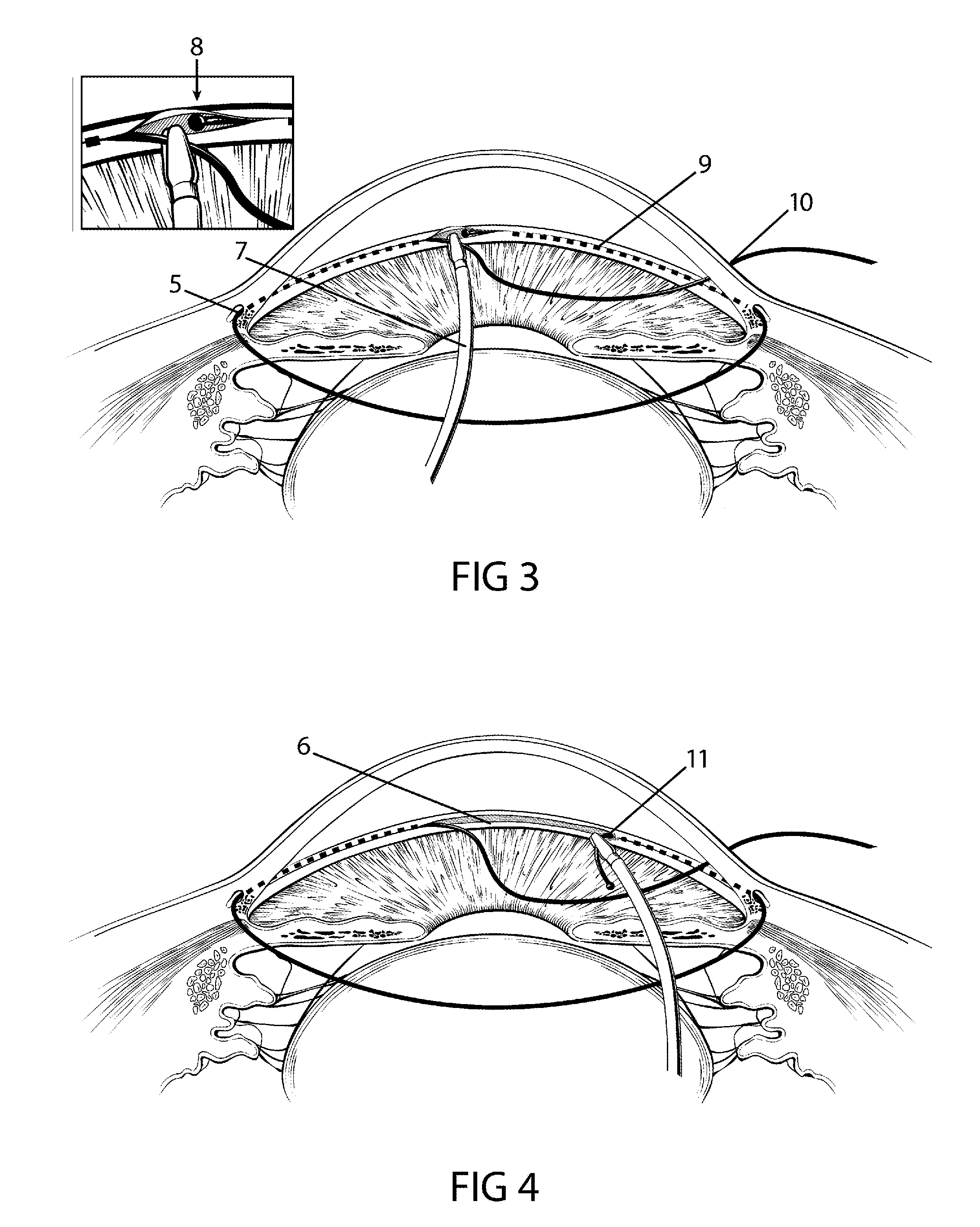 Method and apparatus for treating an ocular disorder