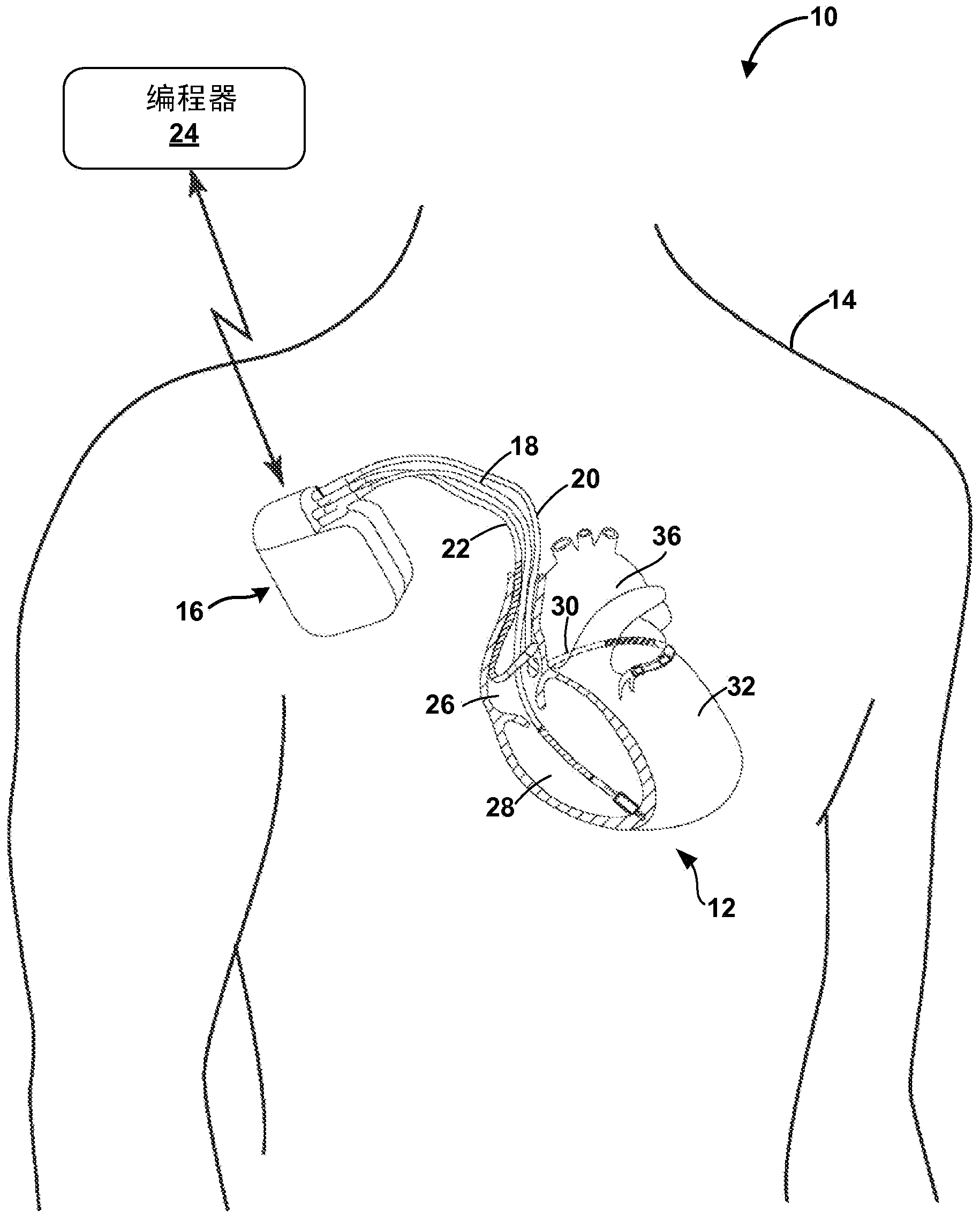 Av nodal stimulation during atrial tachyarrhythmia to prevent inappropriate therapy delivery