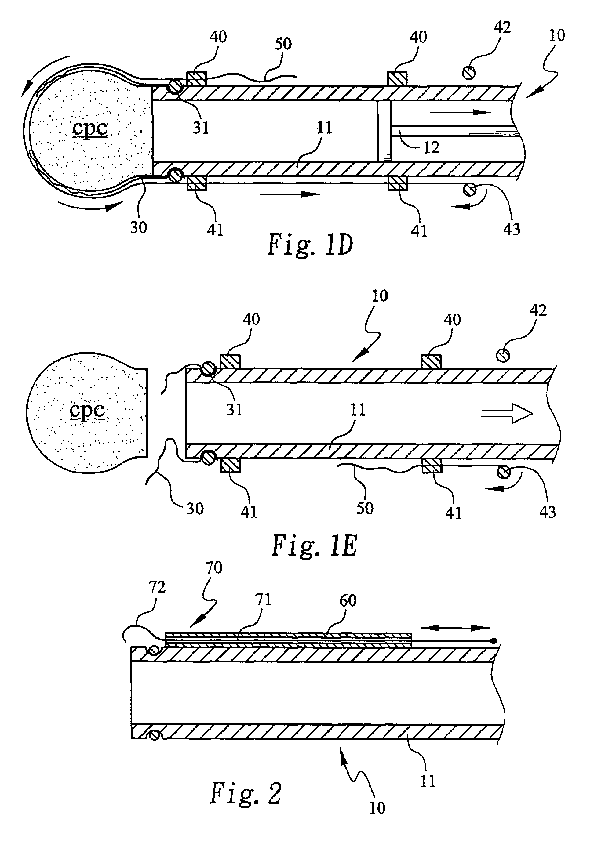 Method for forming a hardened cement in a bone cavity