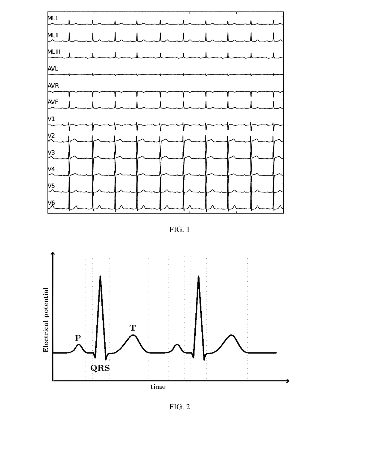 Automatic method to delineate or categorize  an electrocardiogram