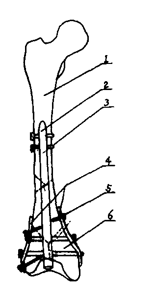 Internal fixator of interamedullary nail jined with steel plate