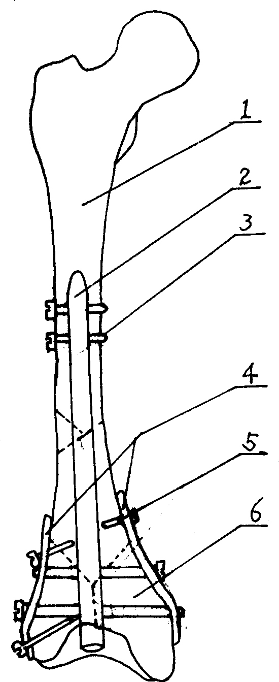 Internal fixator of interamedullary nail jined with steel plate