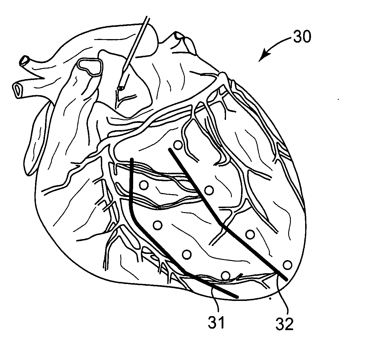 Intramyocardial patterning for global cardiac resizing and reshaping