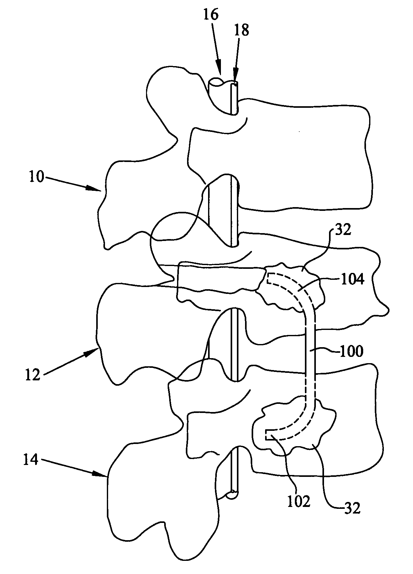 Spinal rod, insertion device, and method of using