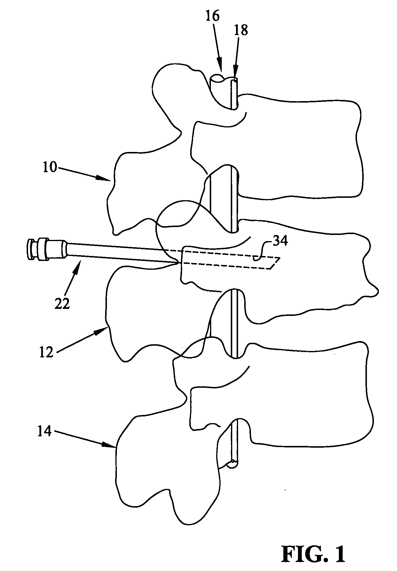 Spinal rod, insertion device, and method of using