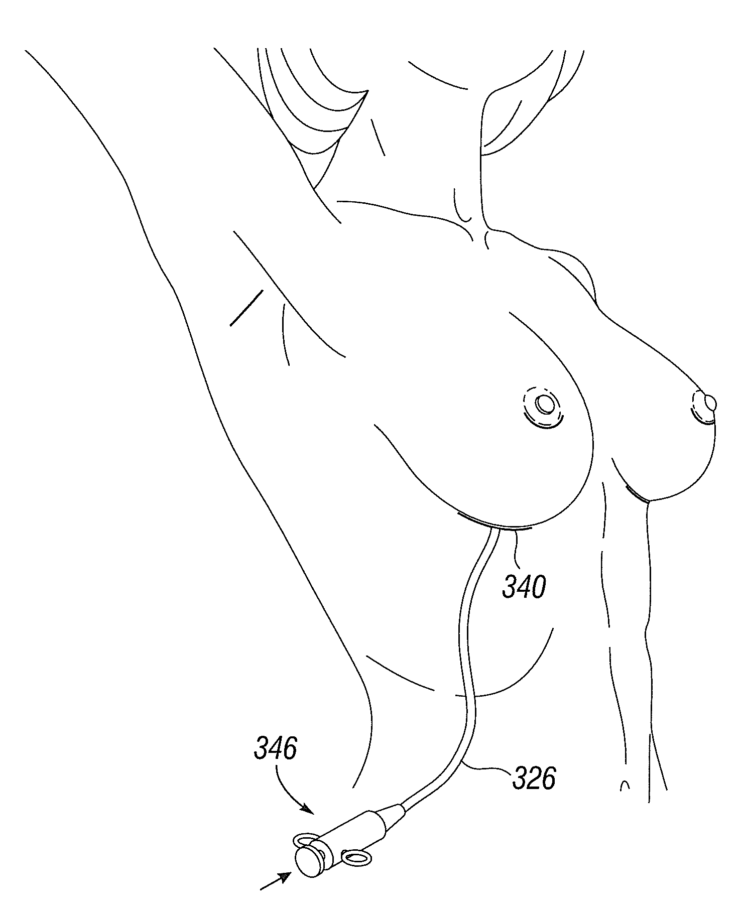 Flush patch for elastomeric implant shell