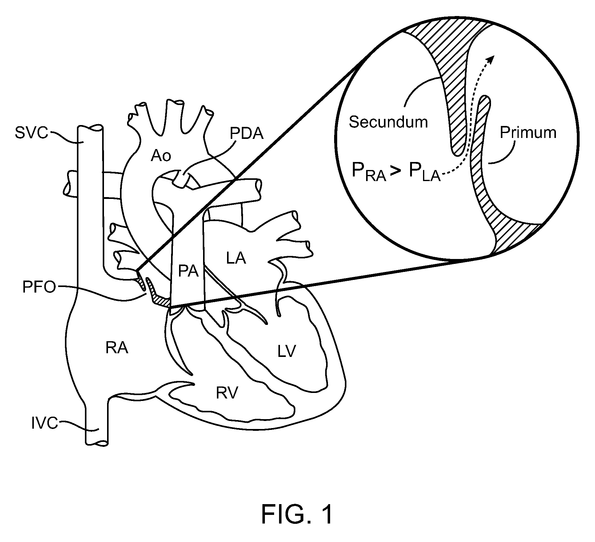 Energy delivery apparatus with tissue piercing thermocouple