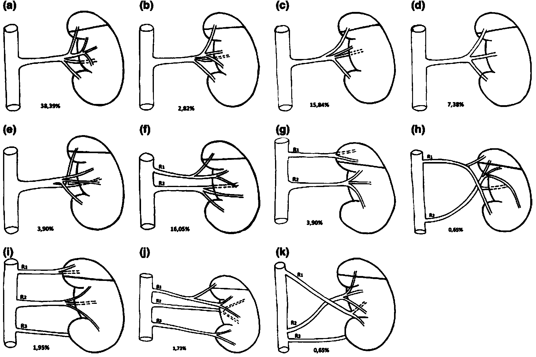 Renal artery blood-supply area segmenting method based on CT contrastographic picture