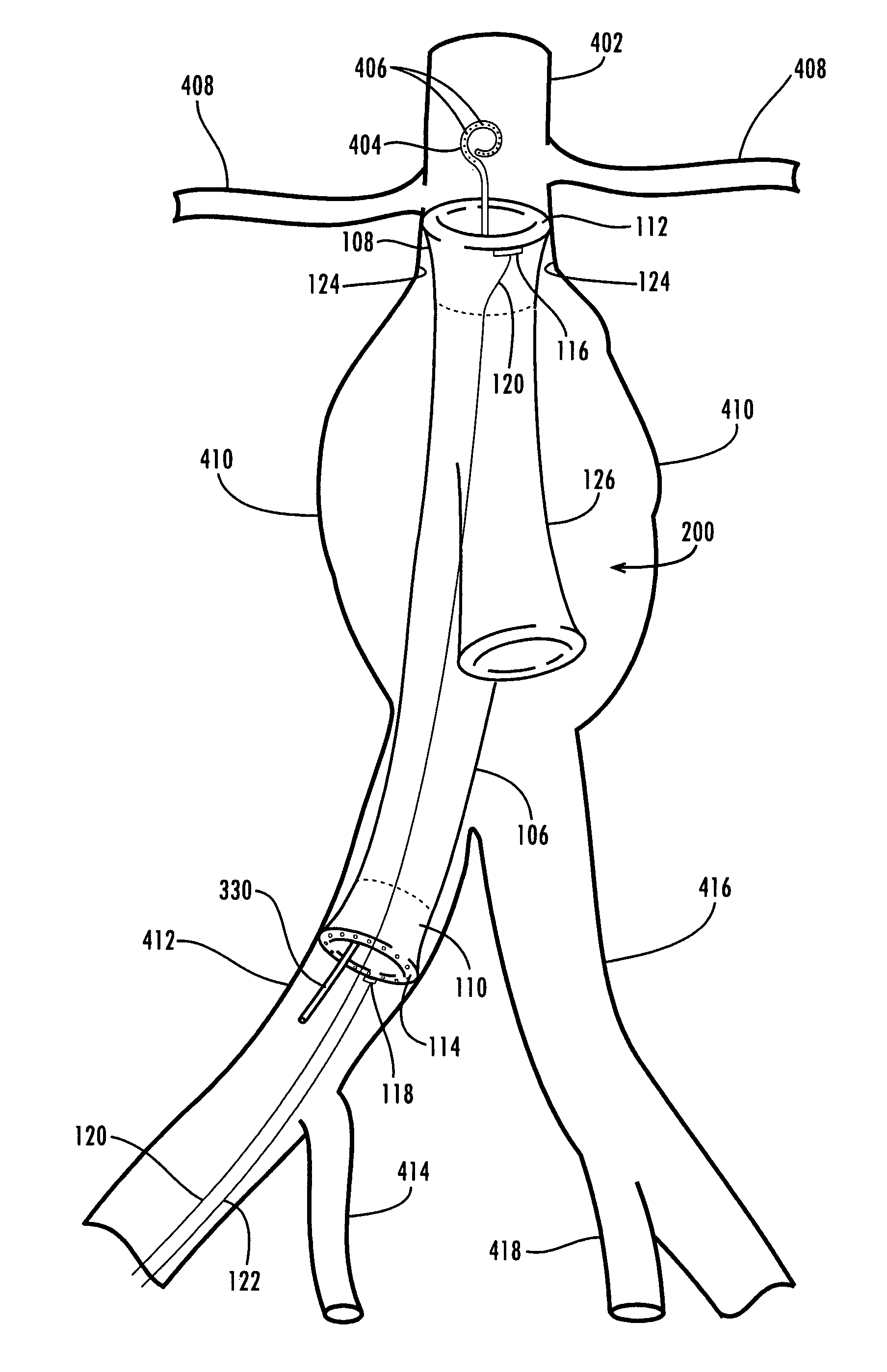 Sealable endovascular implants and methods for their use