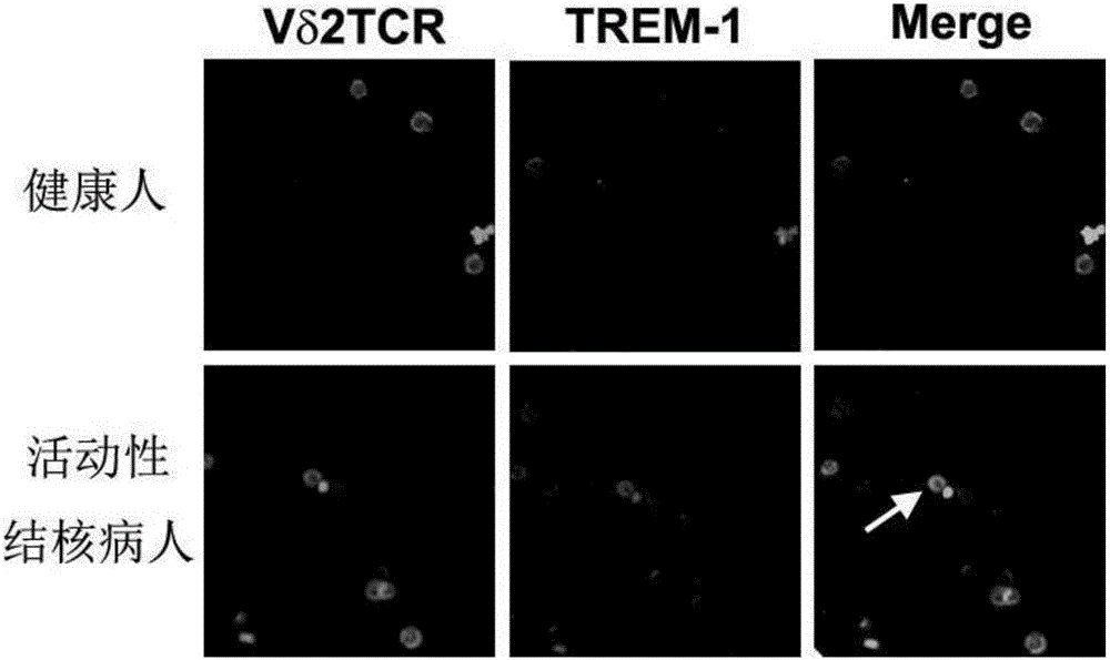 A gamma delta T cell surface activation molecule and kit for rapid diagnosis of active tuberculosis