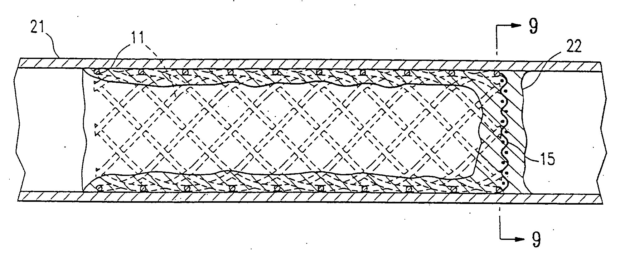 Occluding device and method of use