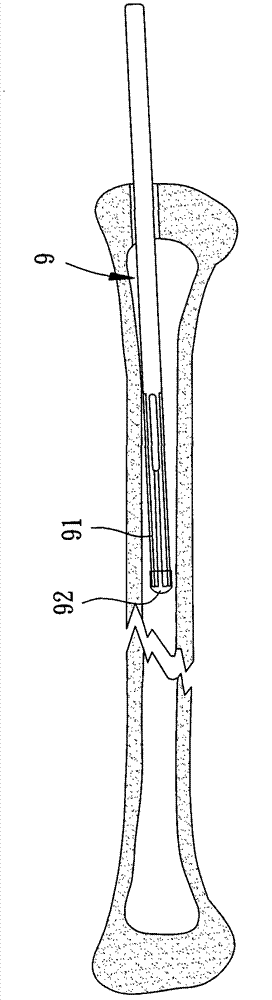 Three-dimension-extending intramedullary nail