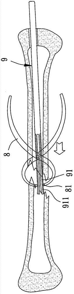 Three-dimension-extending intramedullary nail