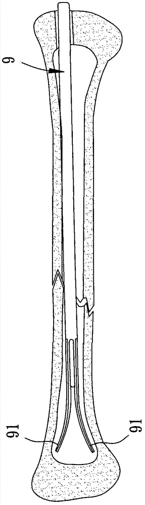 Three-dimension-extending intramedullary nail