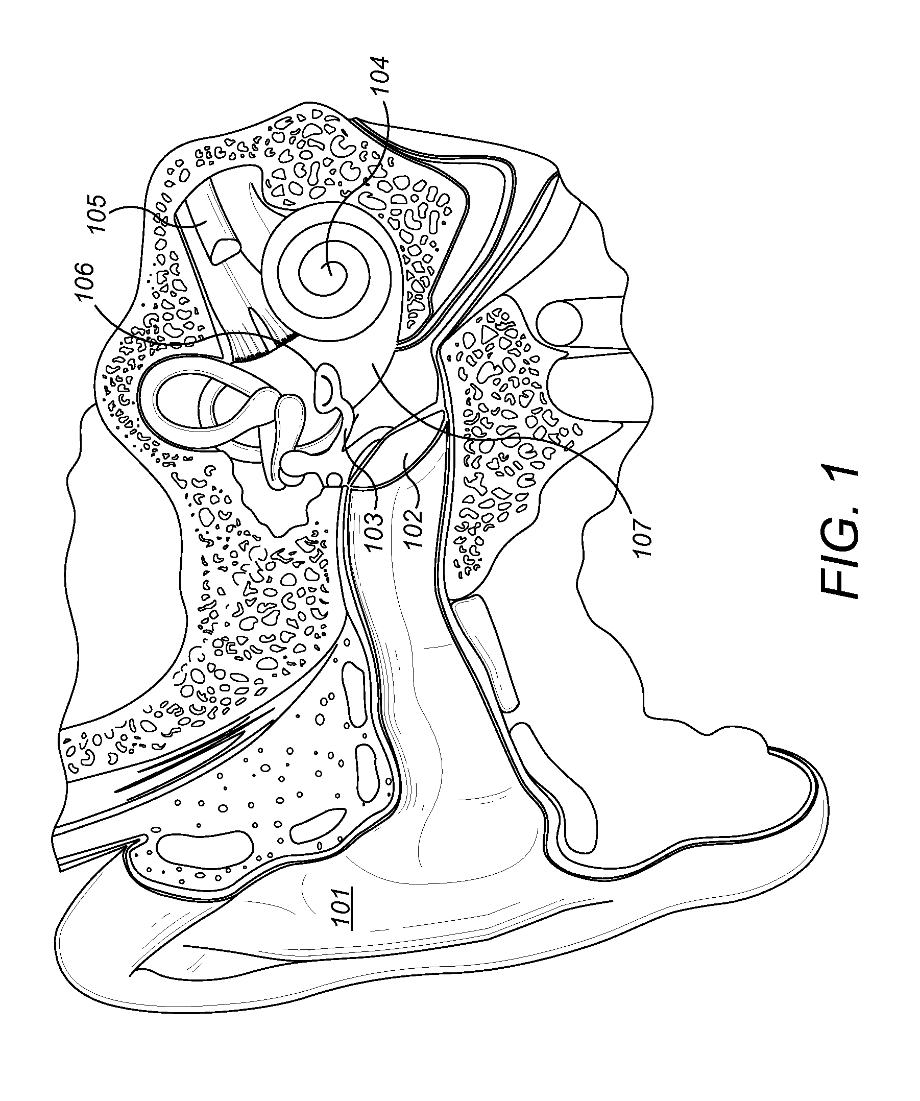 Magnet Arrangement for Bone Conduction Hearing Implant